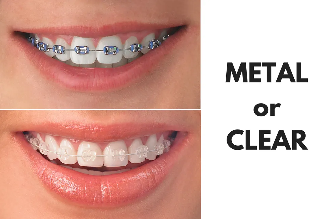 Metal and clear braces comparison