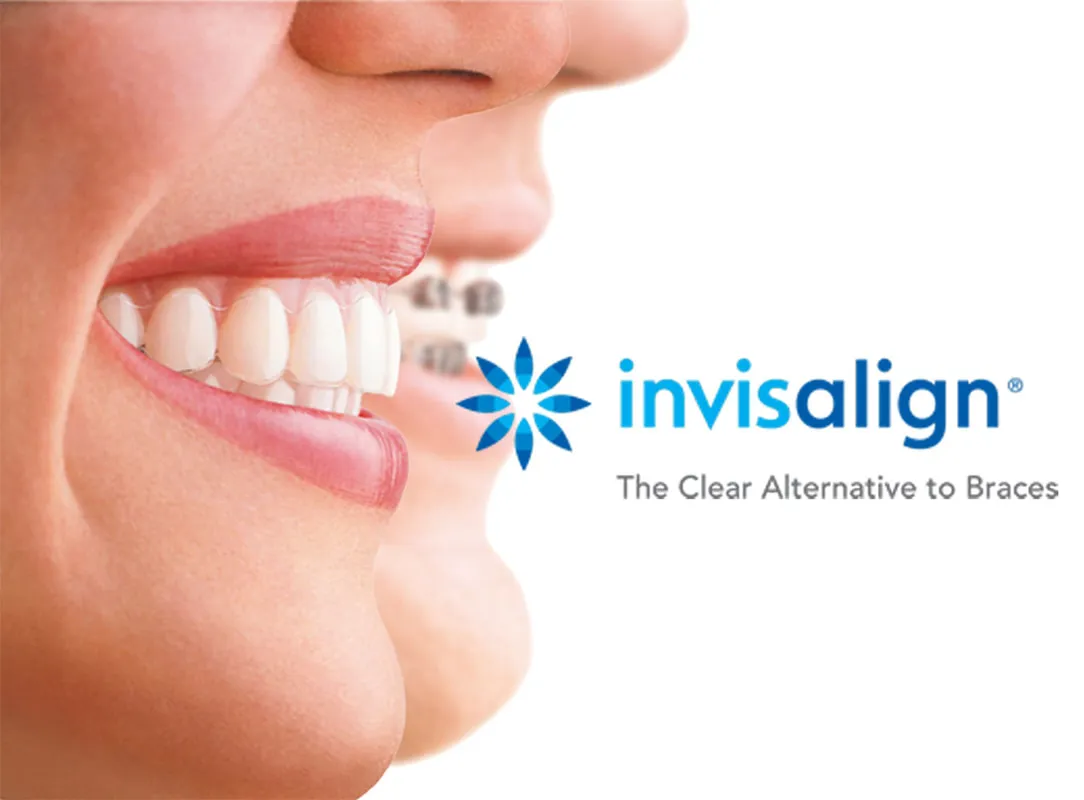 Invisalign clear aligners